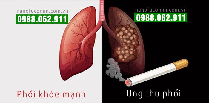 ung thư phổi có chữa được không