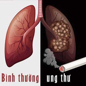 Ung thư phổi có chữa được không và sống được bao lâu?